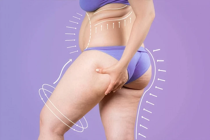 cellulite on the back of the thigh